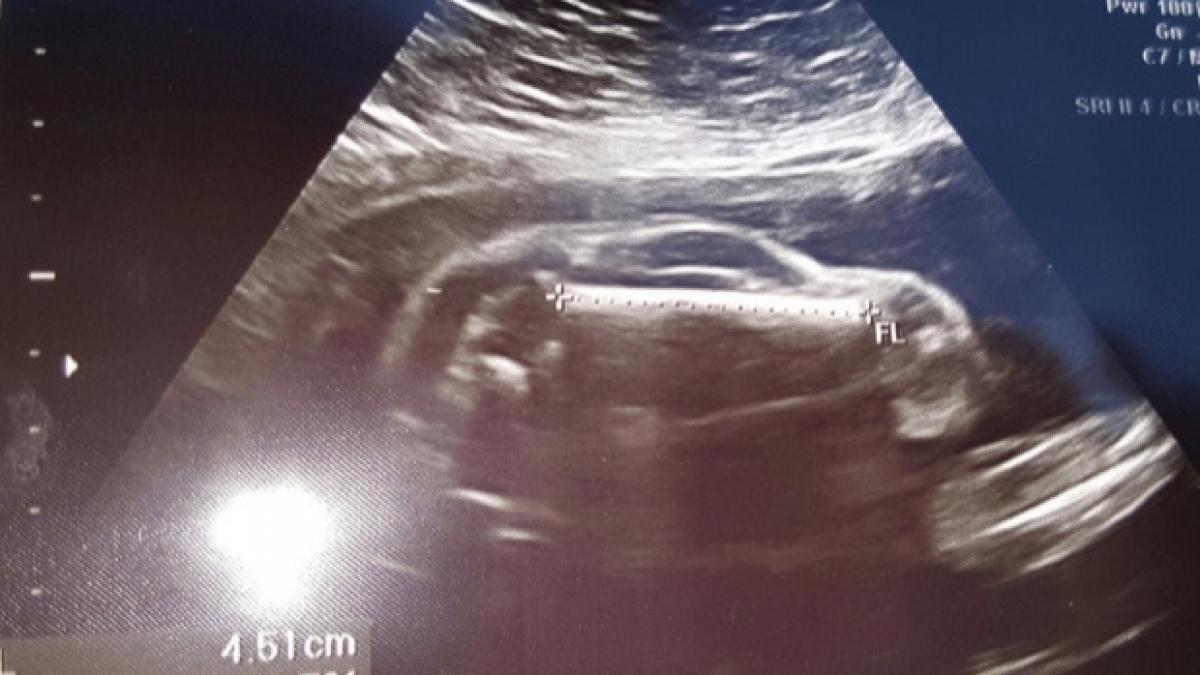 slabise mult in ultimele luni si avea dureri mari de burta ce au descoperit medicii dupa ce i au