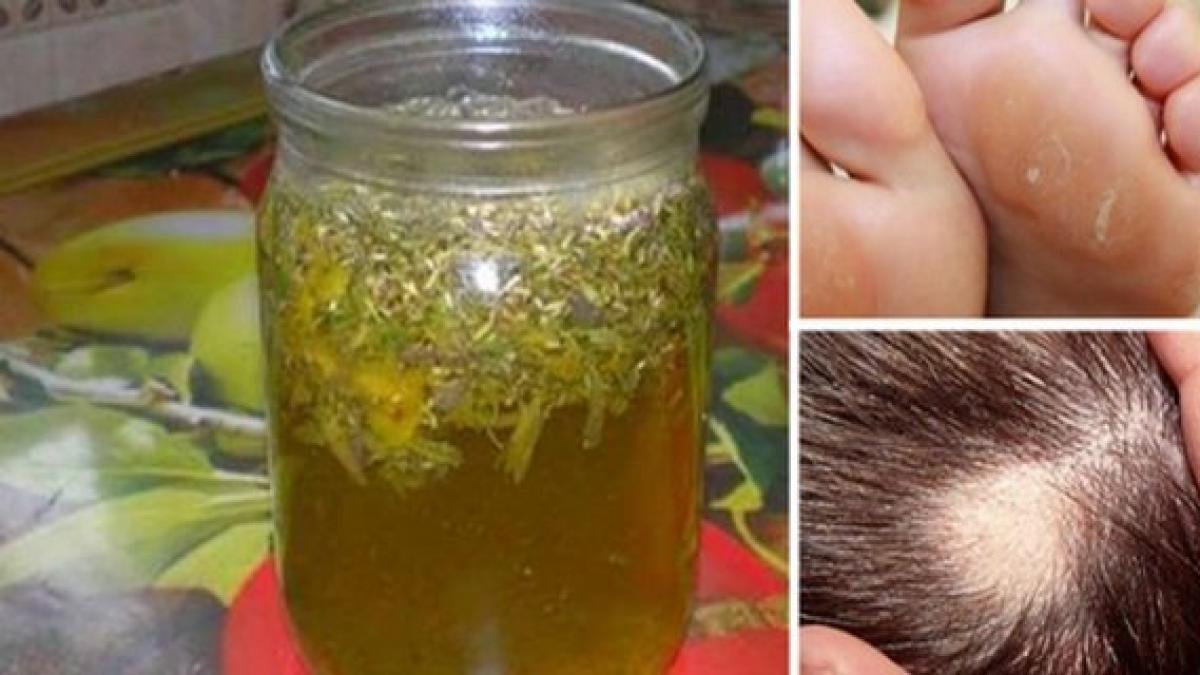 miracolul din borcan tinctura facuta in casa te scapa de eczeme bataturi si trateaza caderea