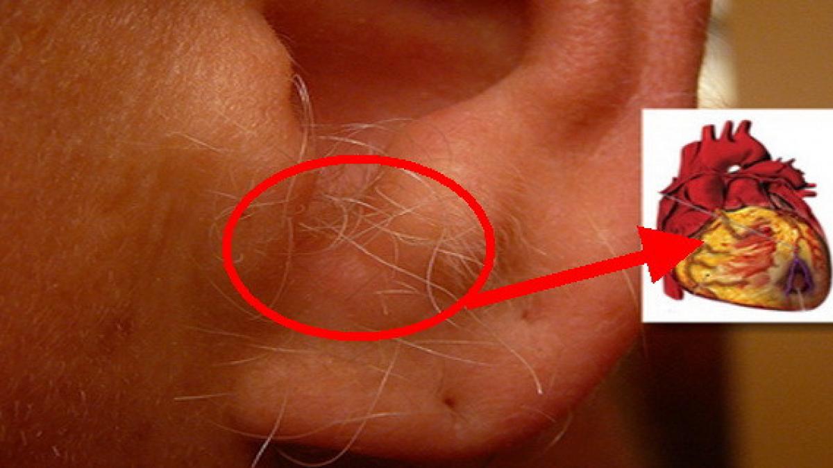 specialistii anunta ai par in ureche atunci ai mari probleme de sanatate