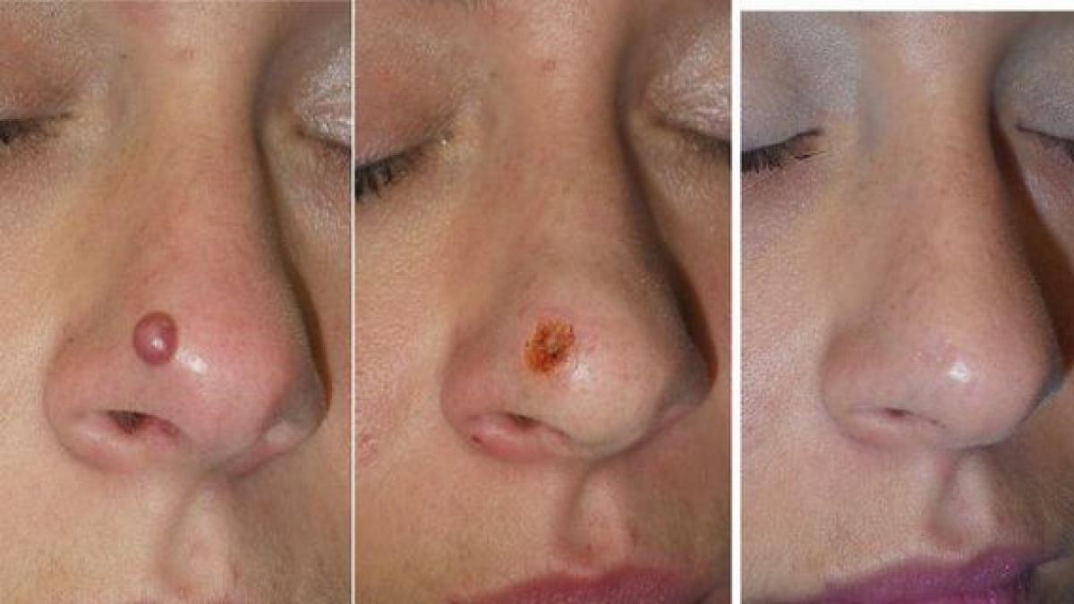 si a dat cu asta pe nas si a scapat de o alunita care ii strica mereu look ul