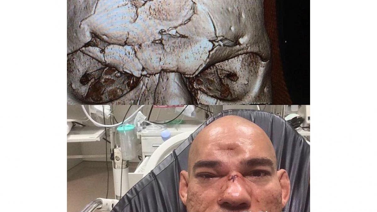 cea mai dura lovitura din ultimii 20 de ani din circuitul mma i a rupt capul