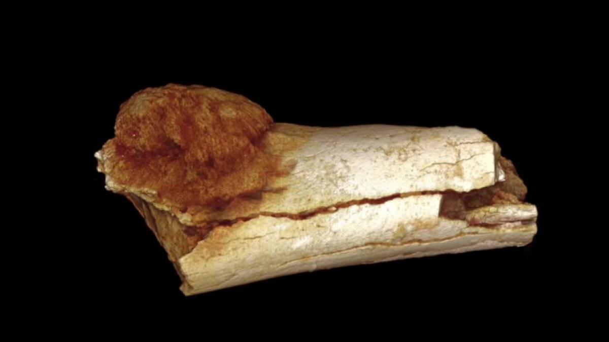 descoperirea care i a luat prin surprindere pe cercetatori cele mai vechi oseminte cu cancer