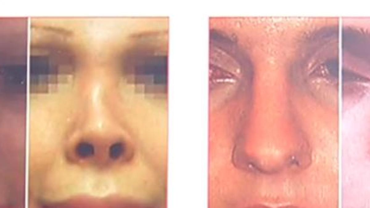 ultima sarlatanie dispozitivul care indreapta nasul