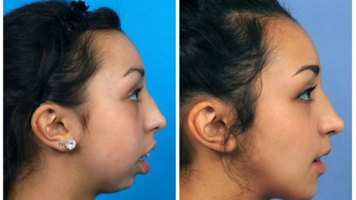 nu ii mai crescuse obrazul de la varsta de opt ani iar dintii ii avea deformati dupa patru ani de