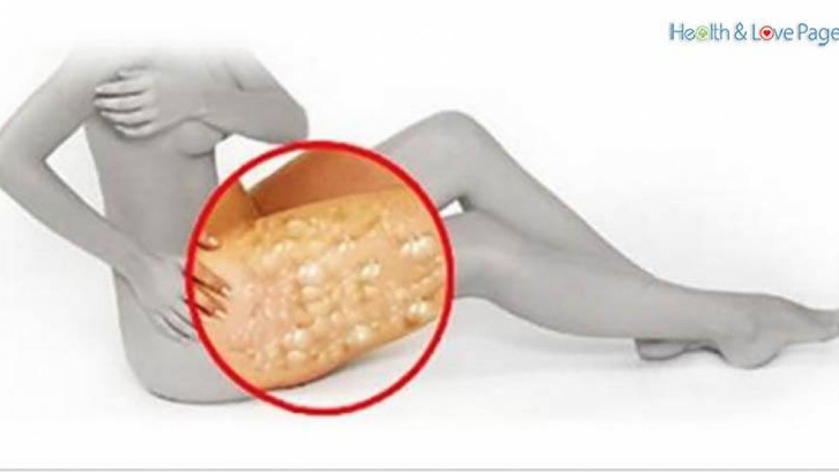 tratament miraculos pentru celulita ingredientul pe care il ai in casa insa nu stiai ca il poti