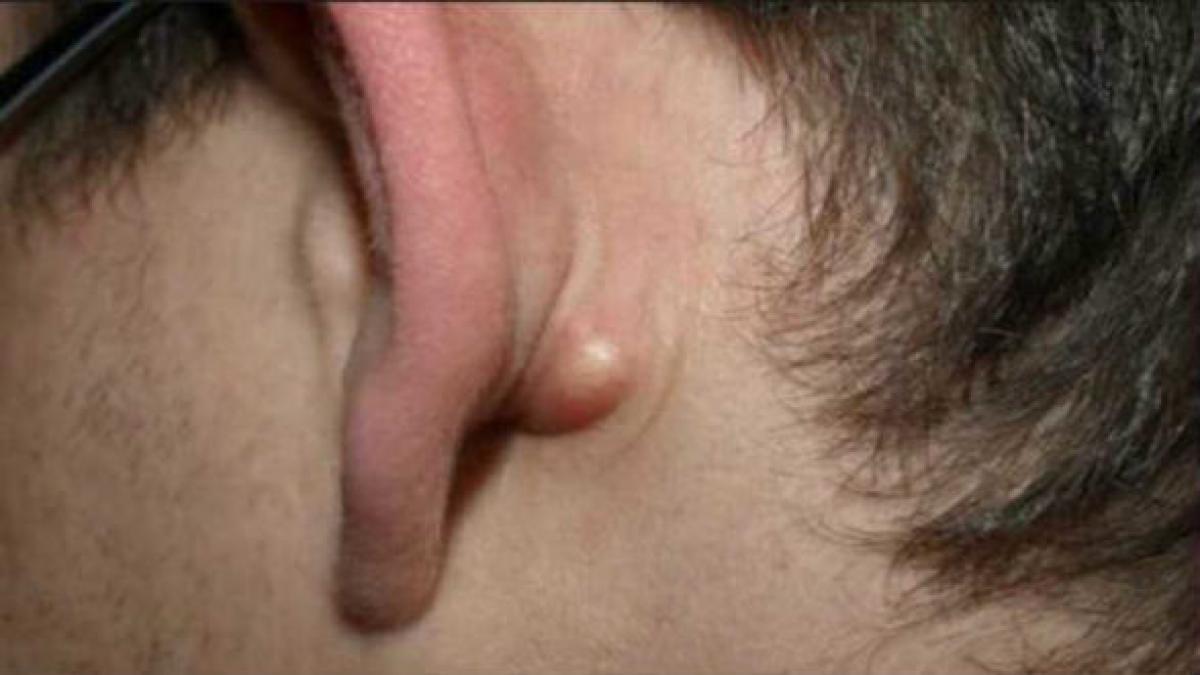 ai semnul asta in spatele urechii poate fi ceva periculos uite ce inseamna