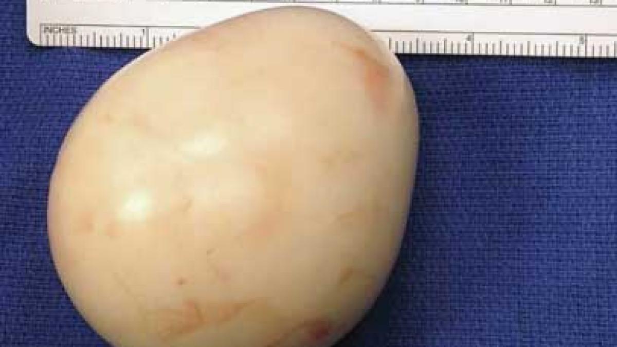 au operat un barbat care mergea tot timpul la toaleta si au fost socati sa descopere acest ou in el