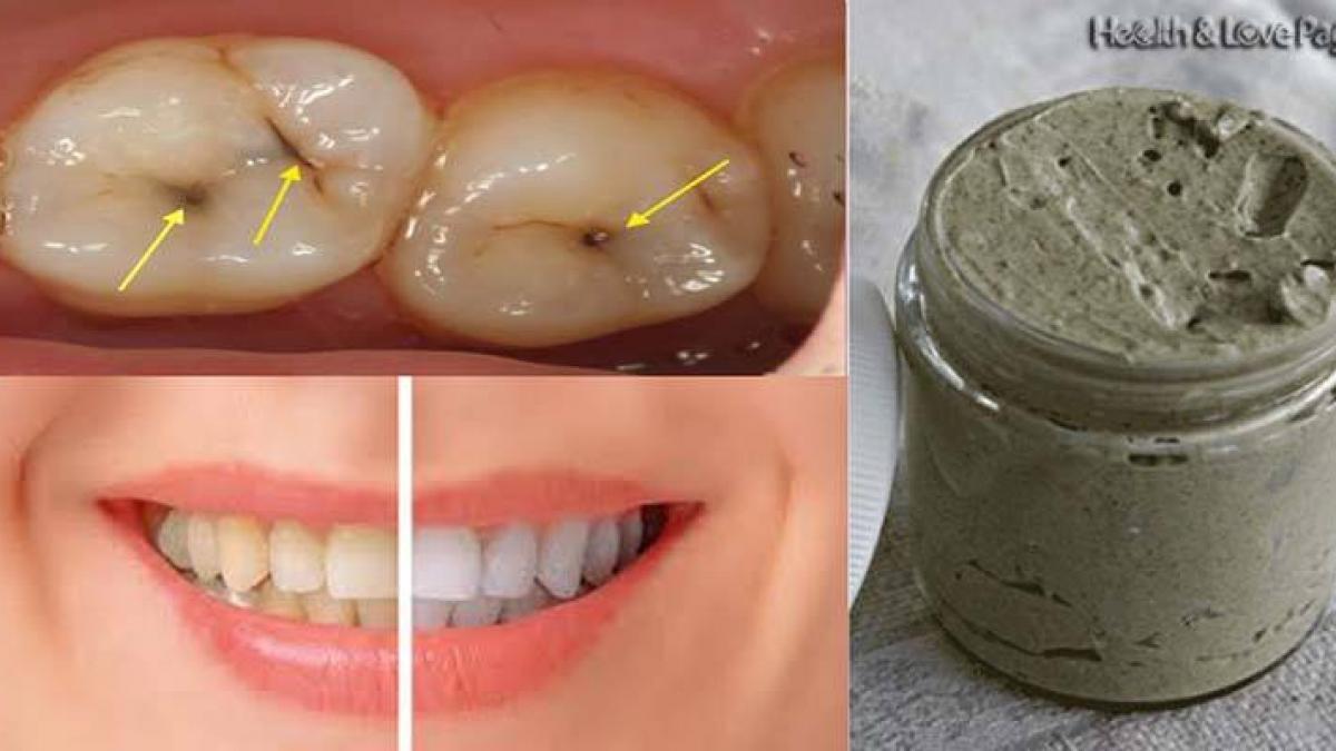 cea mai puternica pasta de dinti pe care ti o poti face acasa vindeca gingiile cariile si albeste