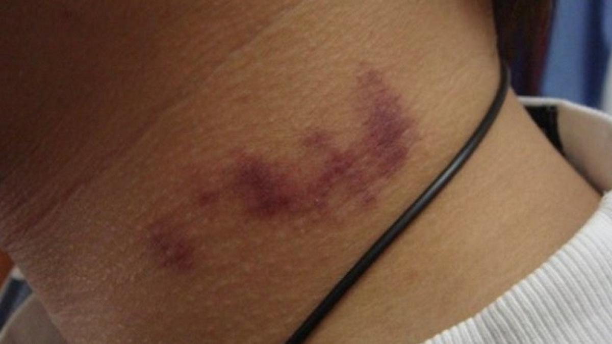 unui tanart i a aparut acest semn pe gat pana dimineata era mort care a fost cauza decesului