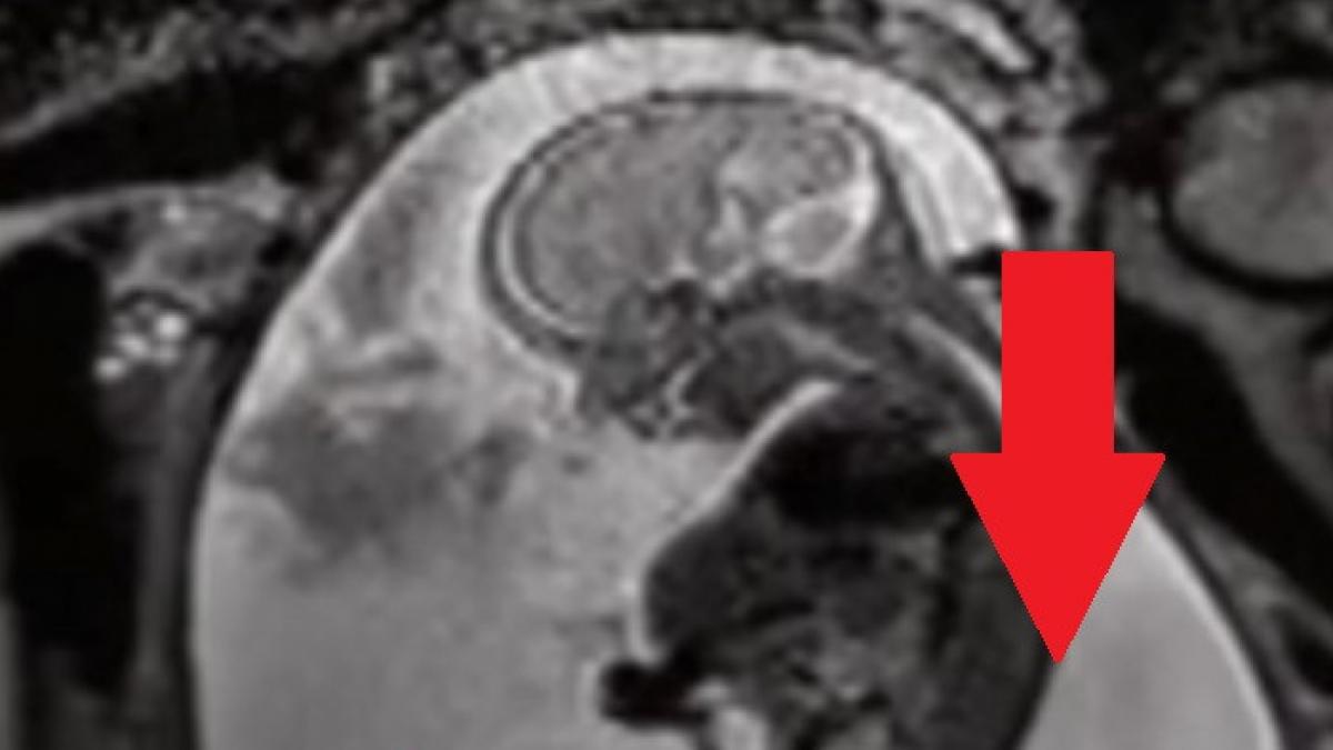 cand s a uitat pe ecografie mama a inmarmurit desi nu avea un frate geaman copilul nu era singur in