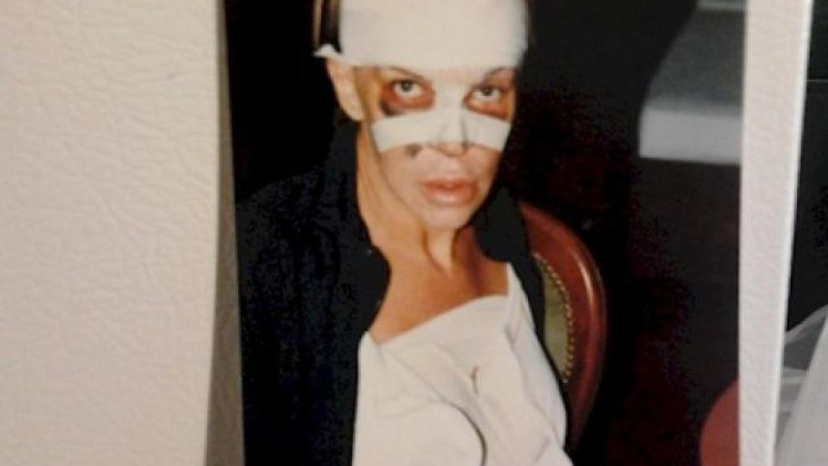 e infiorator cum a ajuns sa arate femeia asta dupa 150 de interventii la buze si pometi pare