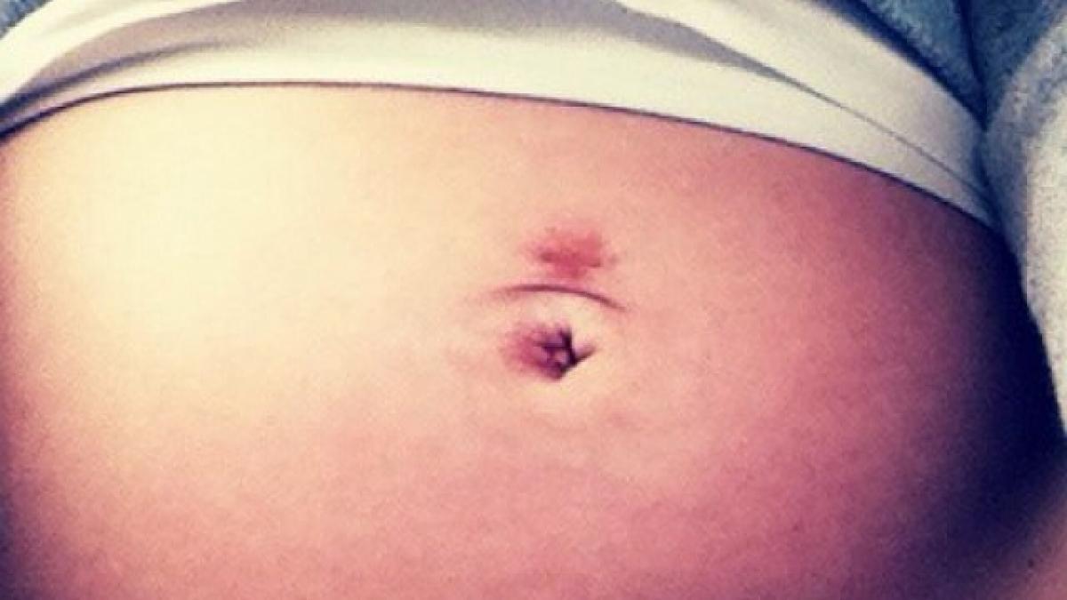 dupa ce s a intors din concediu a observat ca avea un semn ciudat deasupra buricului care se umfla