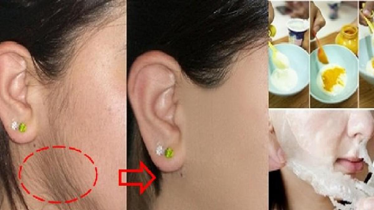 avea par pe fata si toata lumea radea de ea reteta asta miraculoasa a ajutat o sa scape de probleme