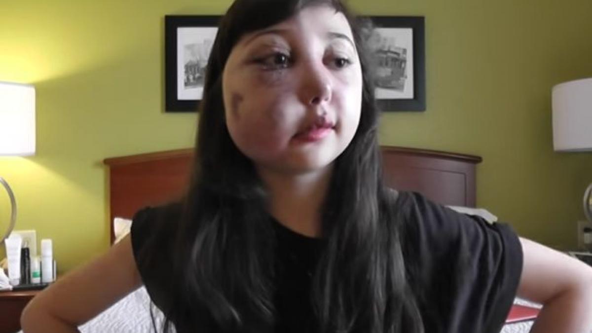 curajul extraordinar al unei fete de 12 ani boala a desfigurat o dar este o sursa de inspiratie