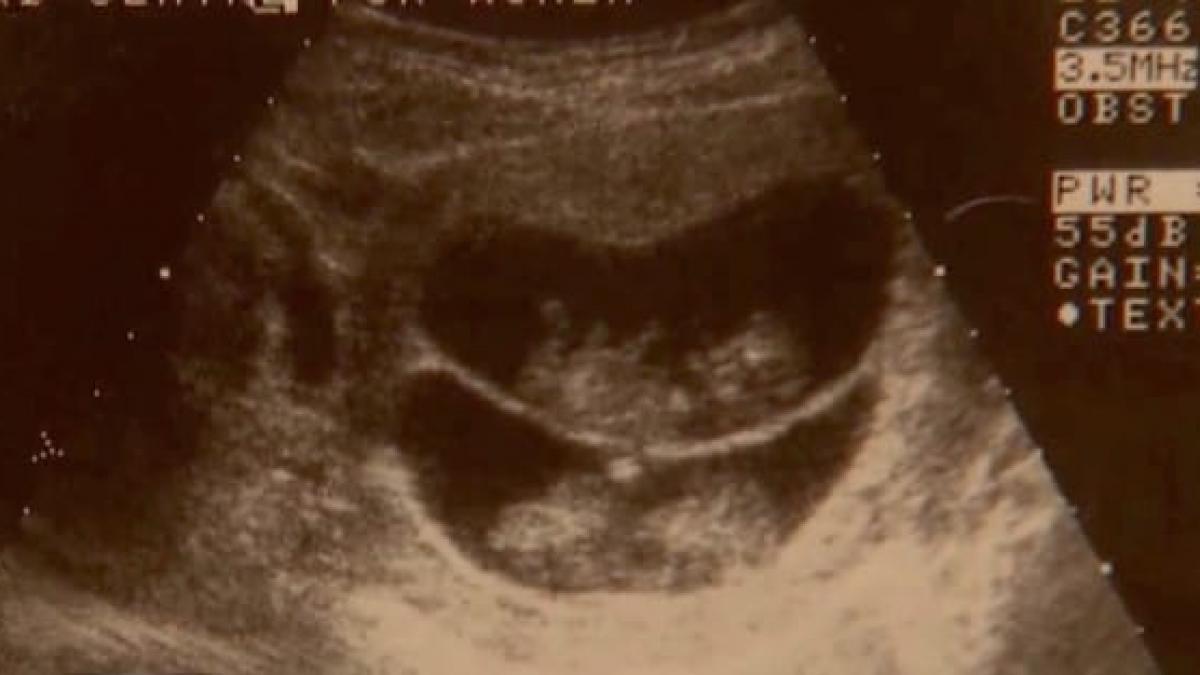 medicii au vazut la ecografie ca are gemene normale mamica asta a fost socata cand si a vazut