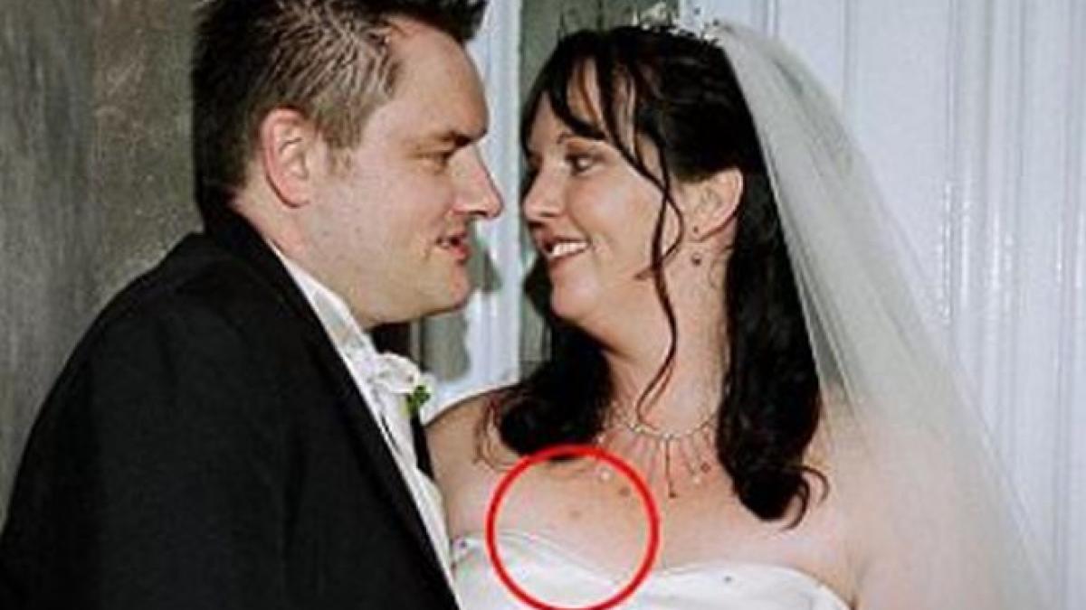 si a dat seama ca sufera de cancer de piele dupa ce s a uitat cu atentie la fotografiile de la