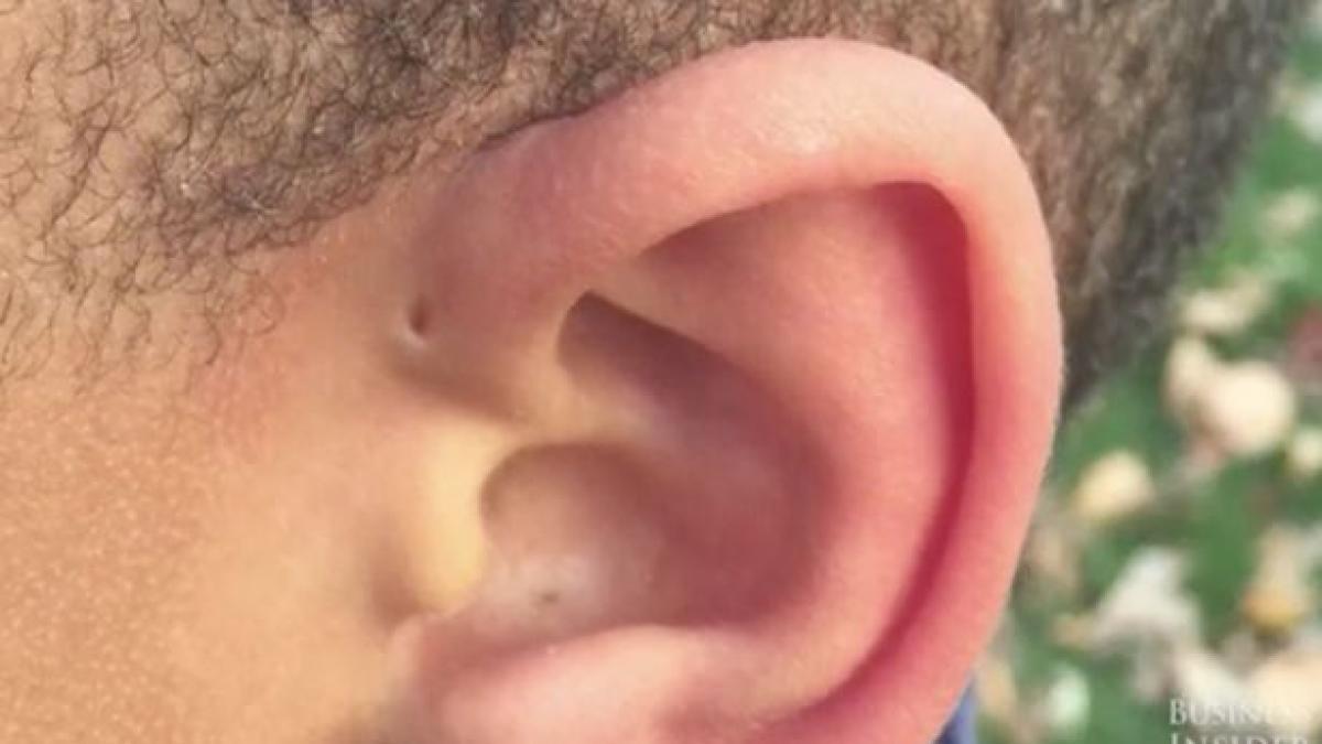 unii oameni se nasc cu mici gauri deasupra urechilor care este explicatia specialistilor