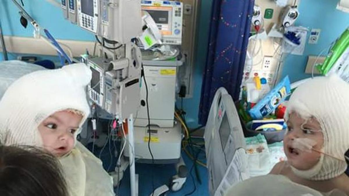 copii cu capete lipite