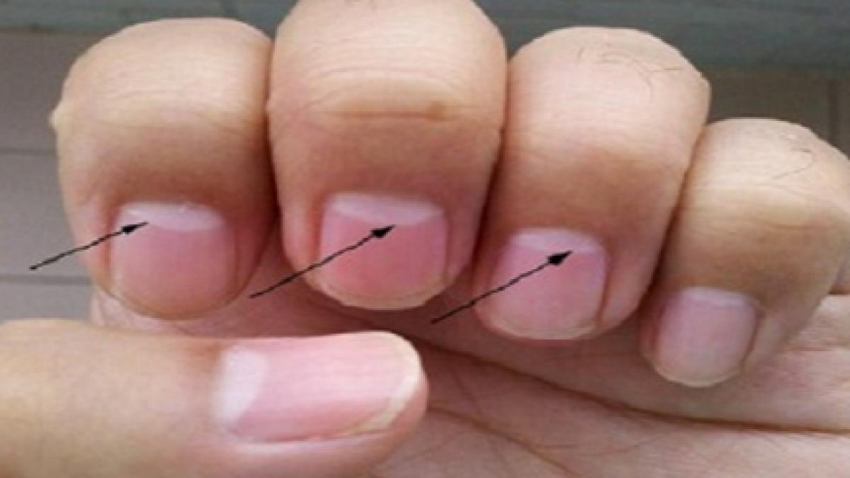 ce indica luna alba de pe unghie mergi de urgenta la medic