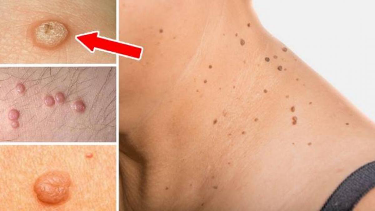 cel mai ieftin si simplu remediu prin care poti indeparta alunitele de pe corp