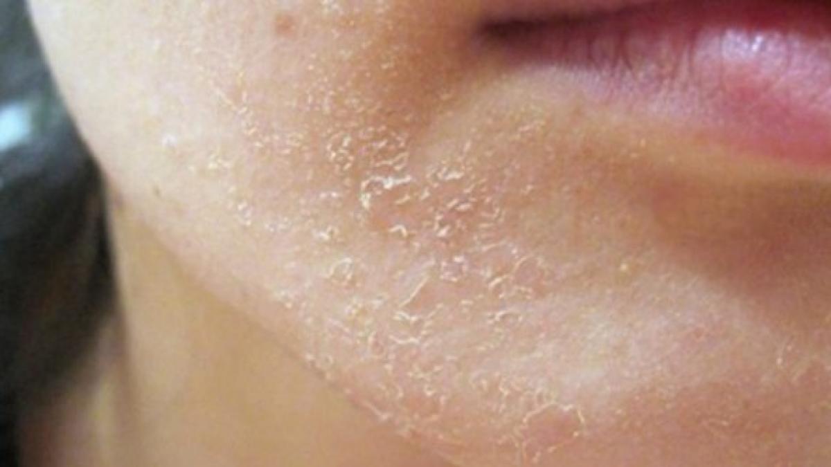 avea mereu pielea uscata si nu intelegea ce se intampla cu ea cum si a revenit instant