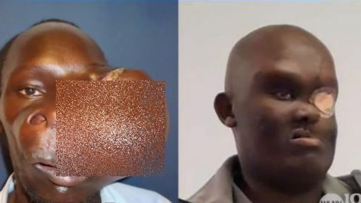 promisiunea incredibila facuta de un medic unui barbat desfigurat de o tumora uriasa