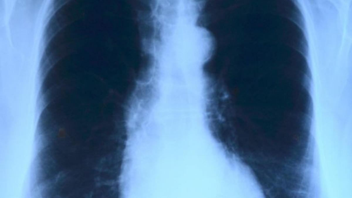 o femeie a trait timp de sase zile fara plamani