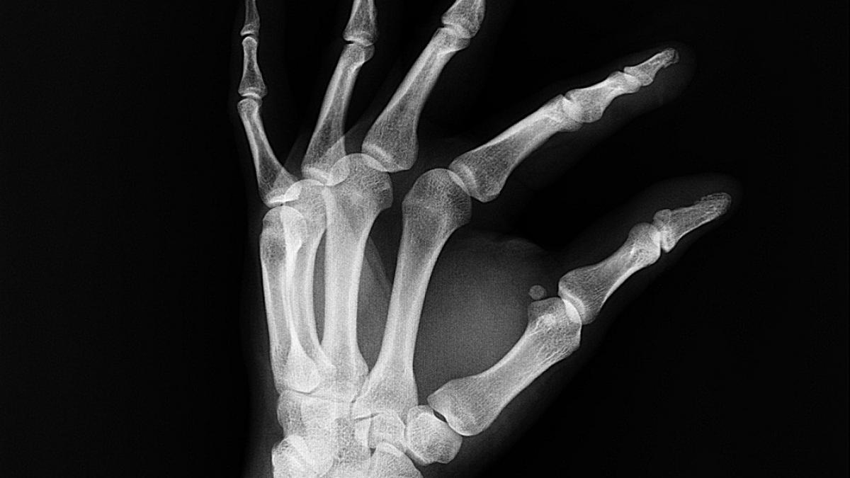 otrava care iti distruge oasele si o bei in fiecare zi