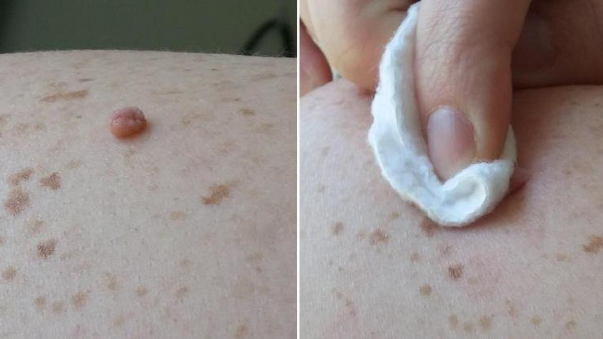 avea multe alunite si nu mai stia cum sa scape de ele a frecat pe ele cu acest ingredient natural