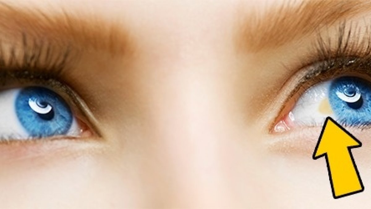 Желтый глаз 13. Здоровые глаза. Сине желтые глаза.