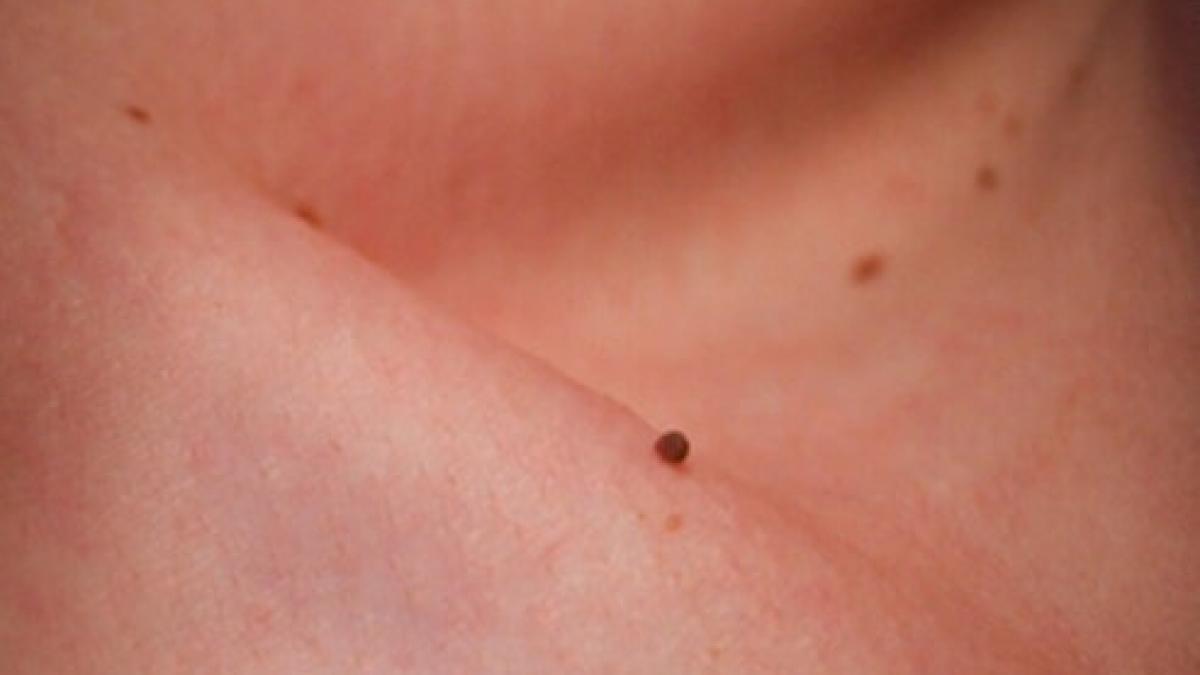 ai multe alunite vezi la ce pericole esti expus