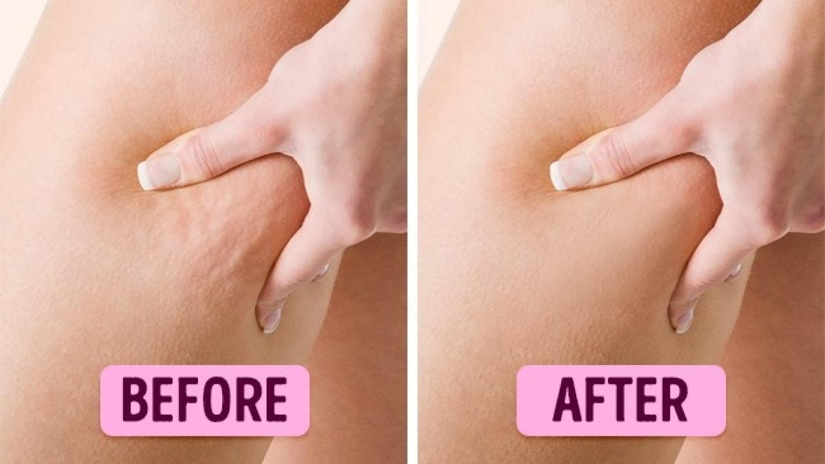 cel mai eficient remediu natural pentru celulita din toate timpurile