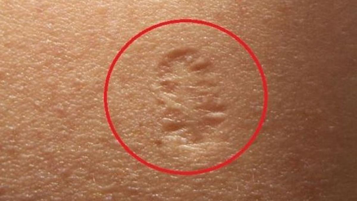 fiecare om are acest semn pe bratul stang toti stiam ca este de la un vaccin dar care este adevarul