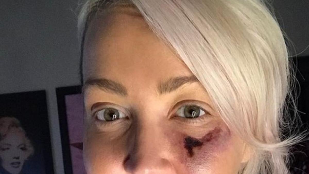 s a trezit din somn cu jumatate de fata arsa s a uitat cu atentie si a descoperit vinovatul pe