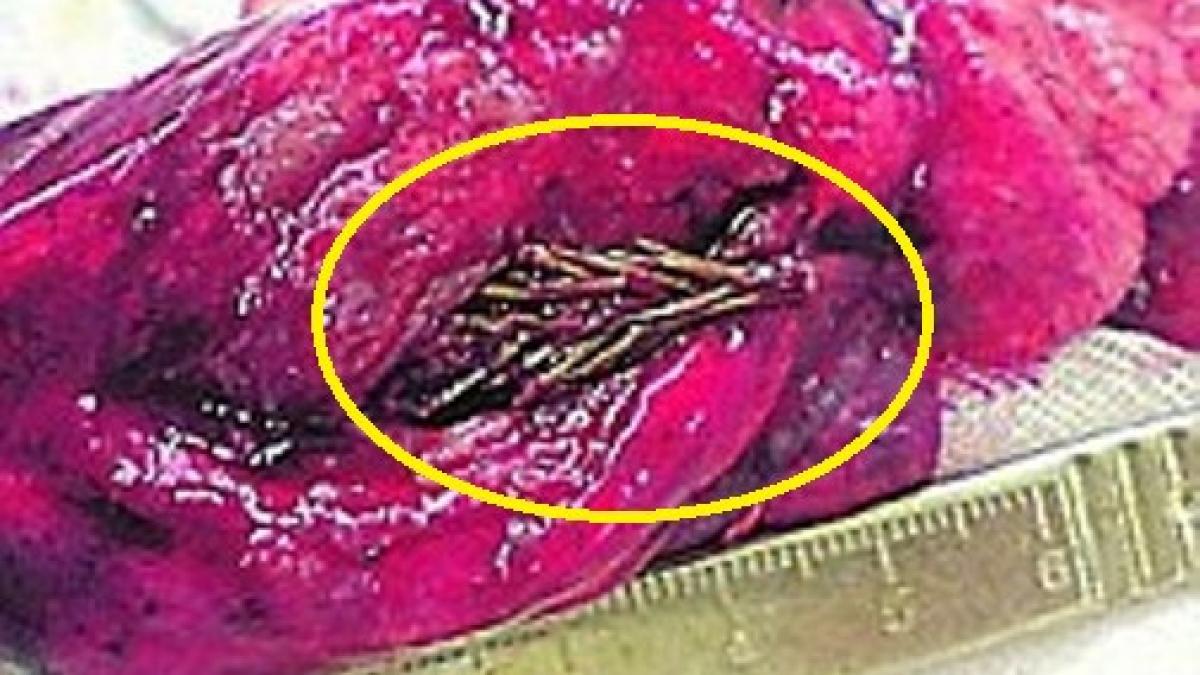 caz socant medicii au crezut ca au halucinatii cand au vazut ce avea pacientul in plamani are