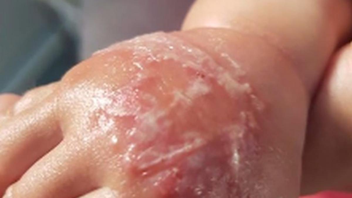 socant bebelus trimis acasa cu mana umflata si infectata de la o branula