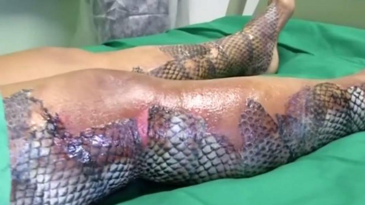 terapie revolutionara au jupuit pesti si au lipit pielea animalelor pe picioarele unui barbat ars