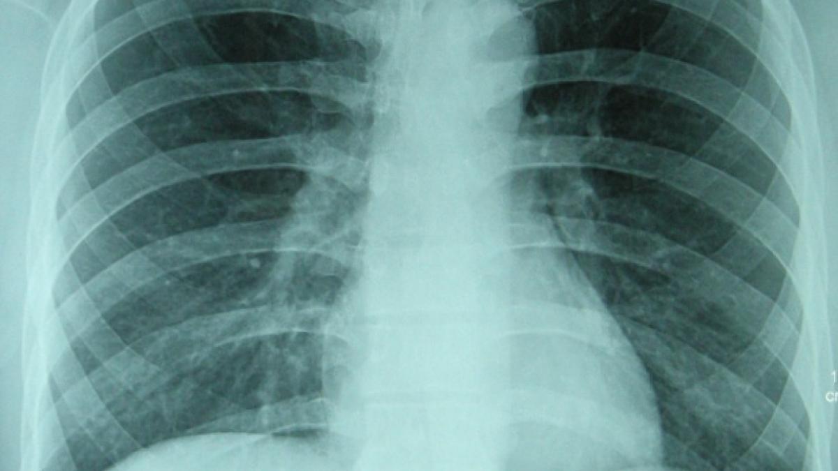 otrava care iti distruge oasele dar pe care o bei in fiecare zi sigur nu stiai asta