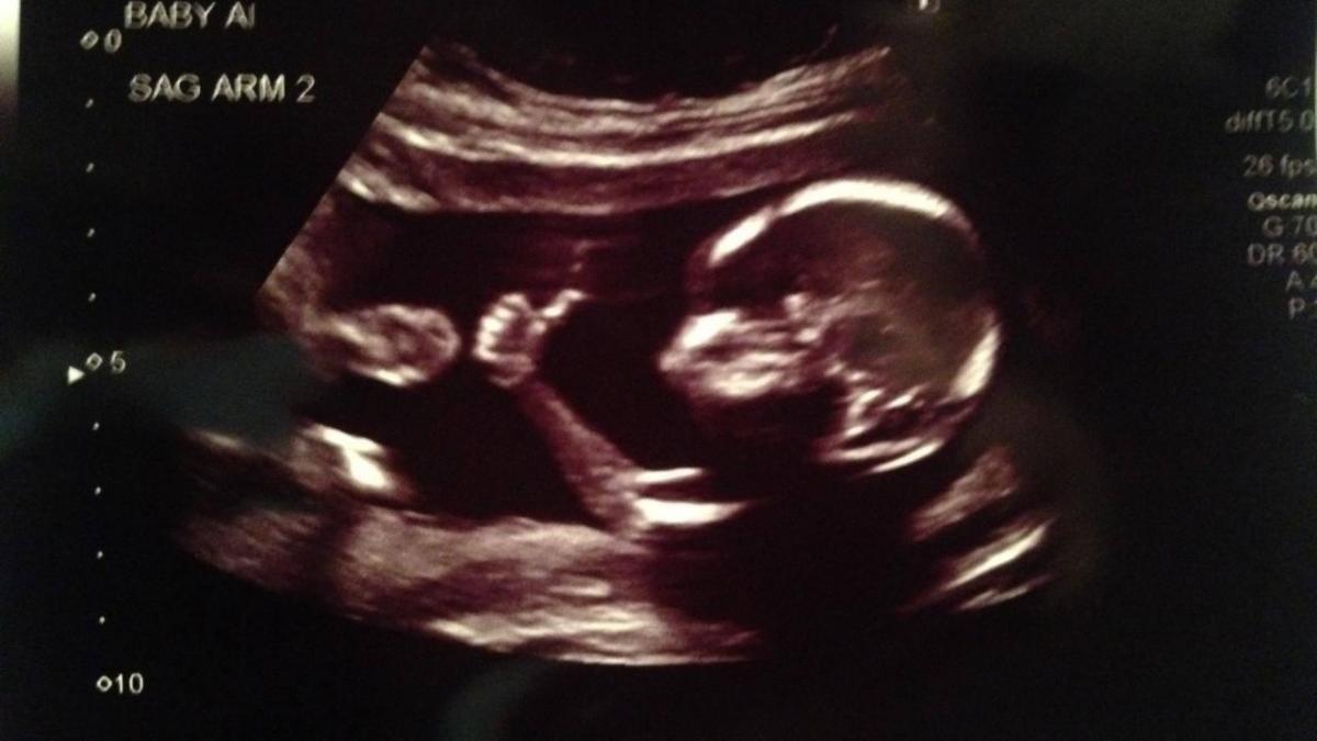 ecografia unui bebelus virala pe internet cum a fost surprins acesta