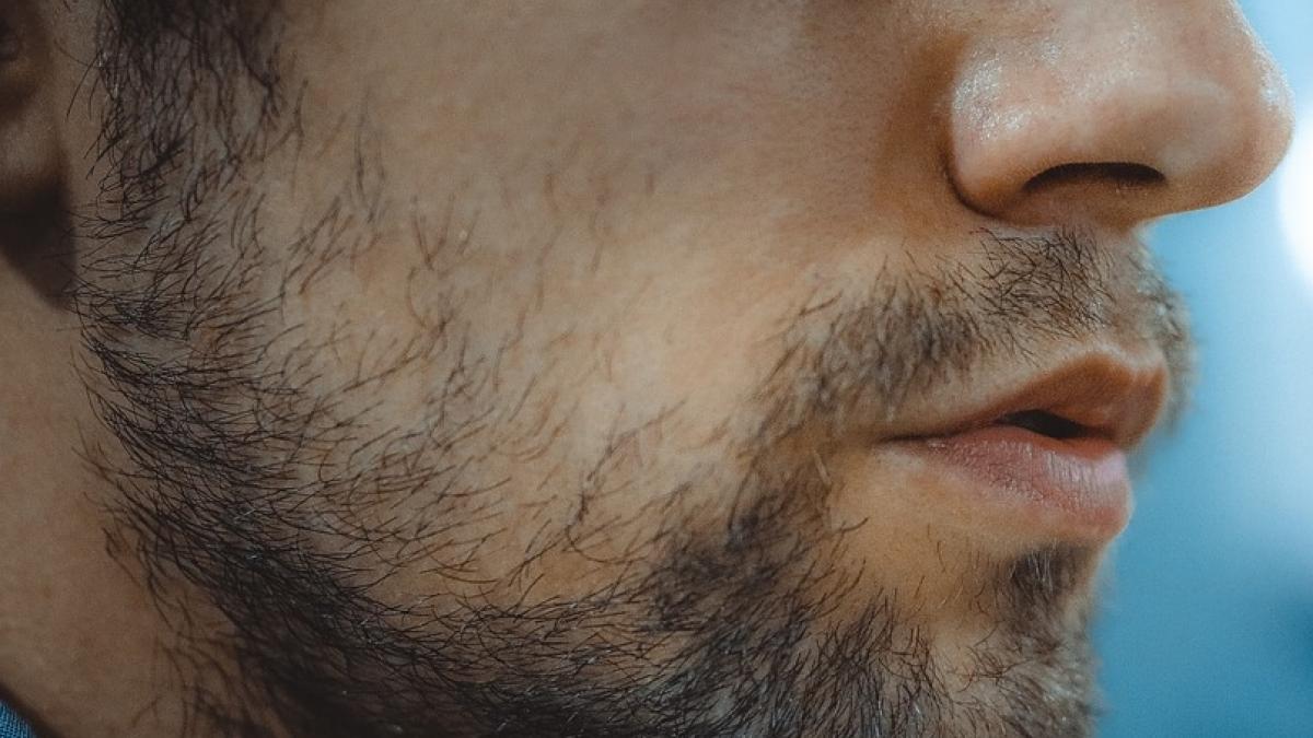 a invins cancerul de doua ori dar radioterapia i a deformat fata o bucata din maxilar i a cazut cum