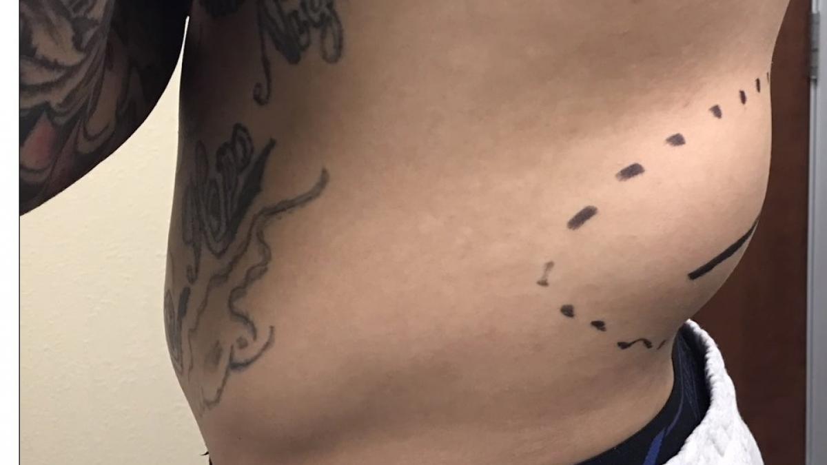 sase ani a stat cu o umflatura uriasa pe spate pana ce si a facut curaj sa mearga la medic cand i a