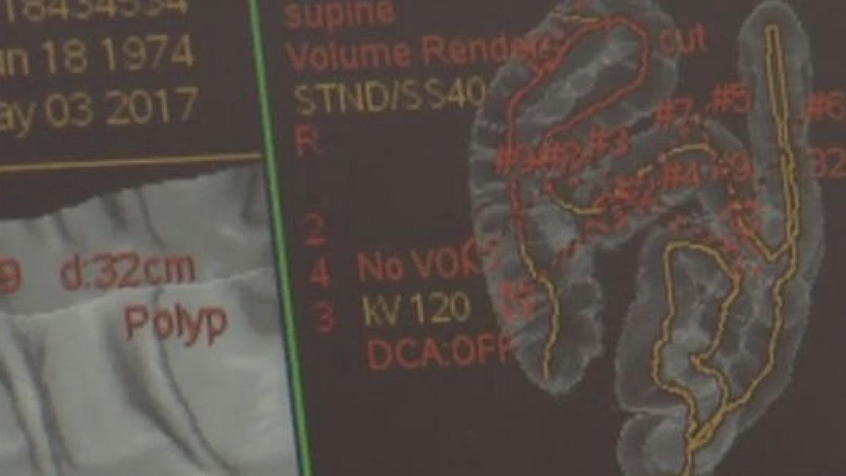 analiza care vede cancerul de colon