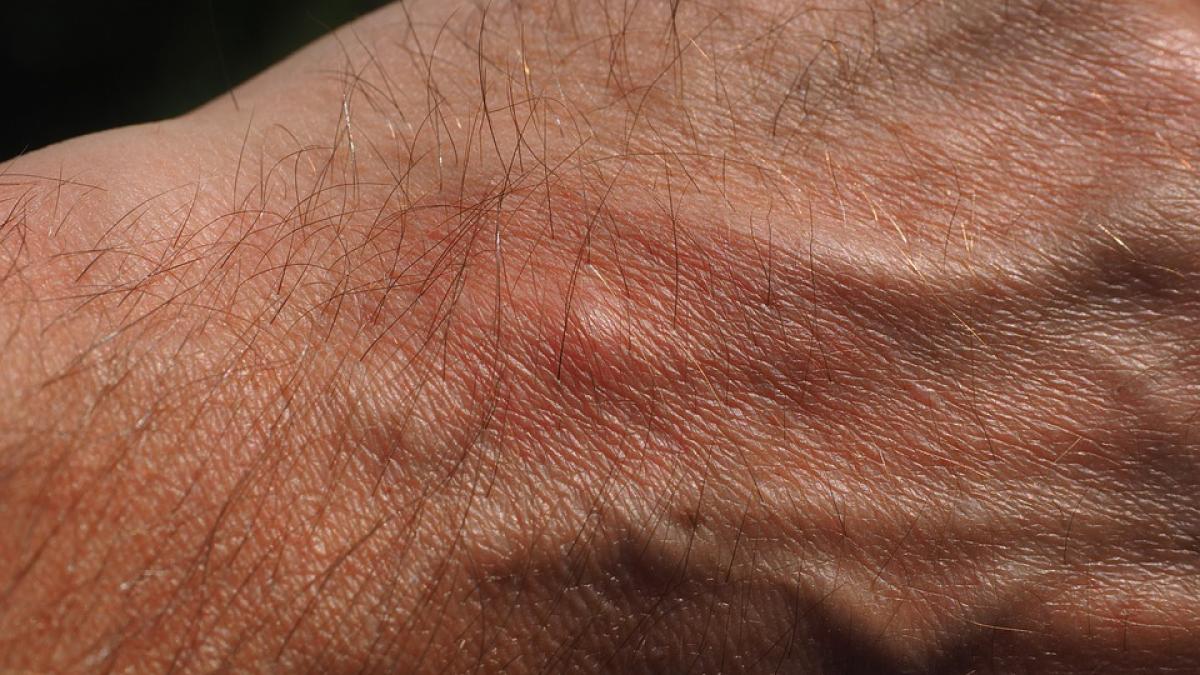 cel mai mare cosmar al verii ia sfarsit cum poti sa scapi usor de tantari si muste