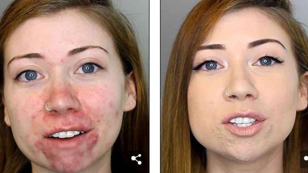 suferea de acnee severa si ii era rusine sa iasa din casa ce a decis tanara rezultatul este uimitor