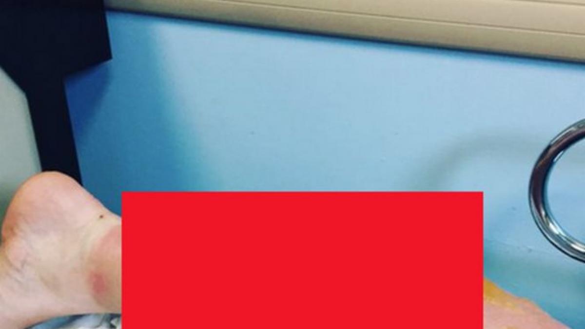 s a copt la soare cum arata picioarele unei femei care a alergat 21 de ore fara oprire