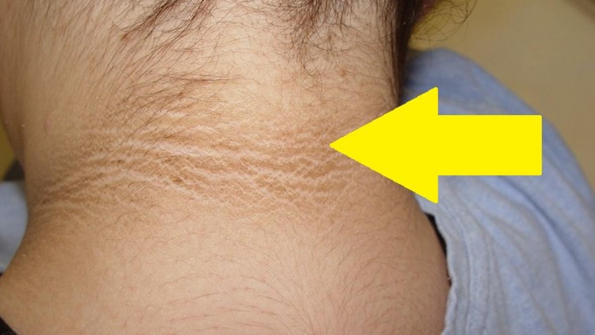 fetitei lor ii aparuse un cerc maroniu in jurul gatului au crezut ca e murdara dar medicii le au