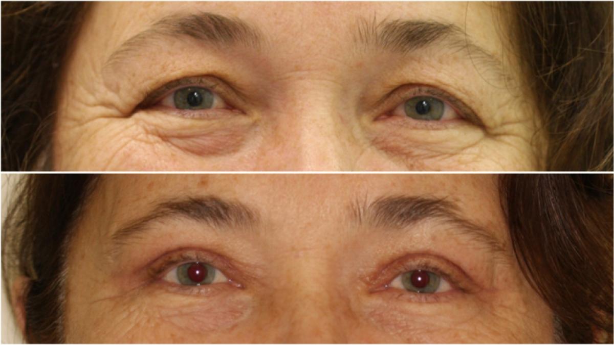 a ajuns la spital cu o durere groaznica la un ochi iar medicii i au spus ca are cataracta totusi