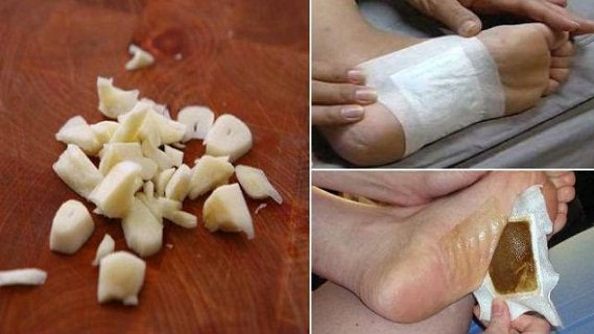 a tocat ceapa si usturoi si le a pus pe talpa inainte de somn ce i s a intamplat de dimineata