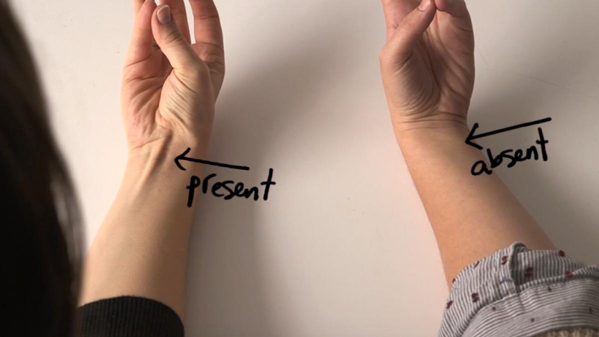 dovezile evolutiei sunt chiar in corpul tau de ce la unii oameni acest tendon nu este vizibil