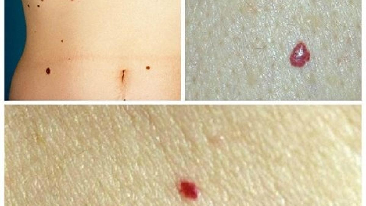 cum iti dai seama daca alunitele tale sunt cancerigene semnele pe care nu trebuie sa le ignori